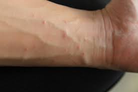 scabies 4