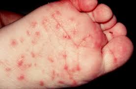 scabies1